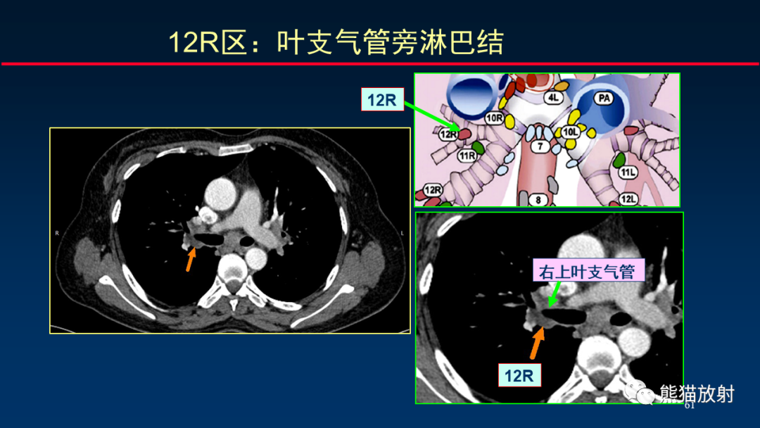 影像PPT - 【PPT】纵隔与肺门淋巴结的识别与精准CT分区-61
