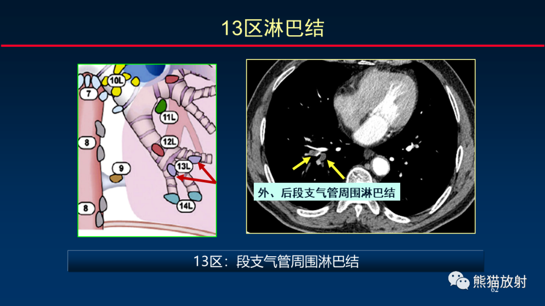 影像PPT - 【PPT】纵隔与肺门淋巴结的识别与精准CT分区-62