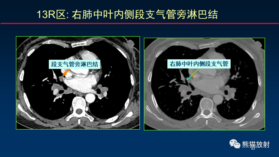 影像PPT - 【PPT】纵隔与肺门淋巴结的识别与精准CT分区-63