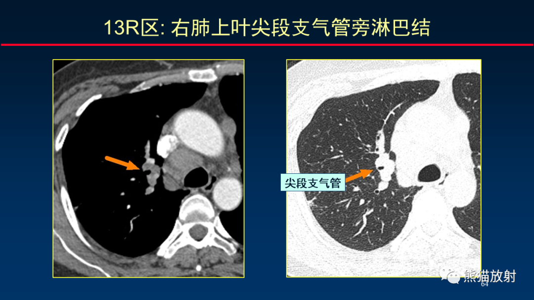 影像PPT - 【PPT】纵隔与肺门淋巴结的识别与精准CT分区-64