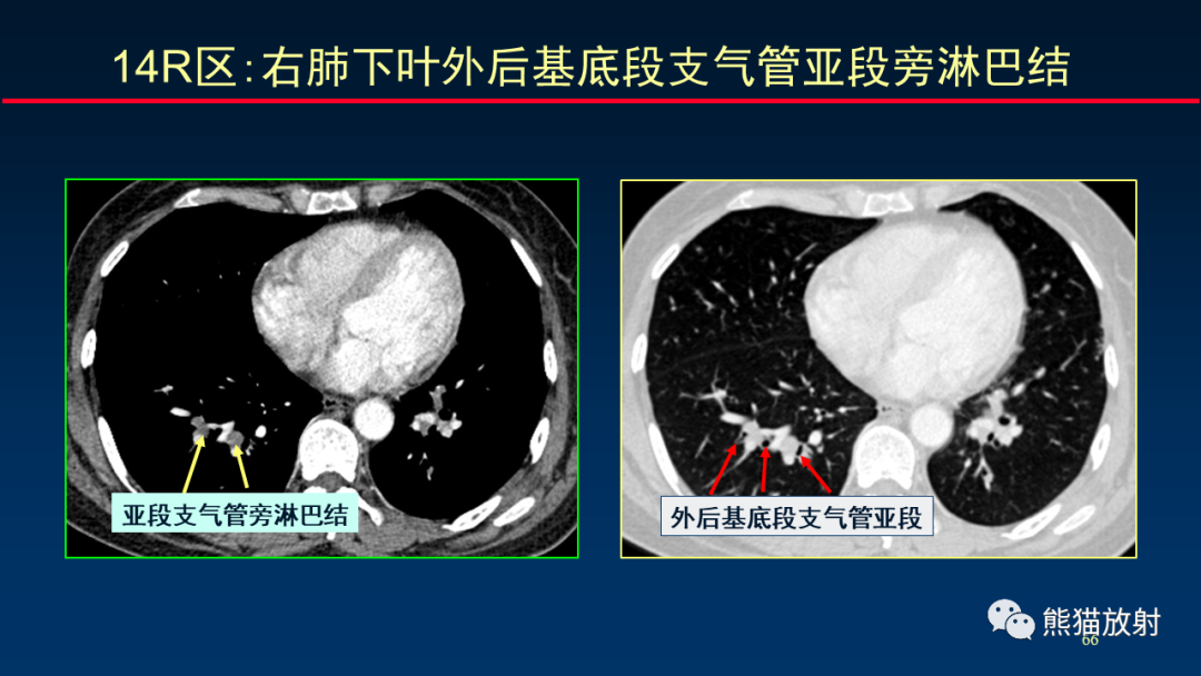 影像PPT - 【PPT】纵隔与肺门淋巴结的识别与精准CT分区-66
