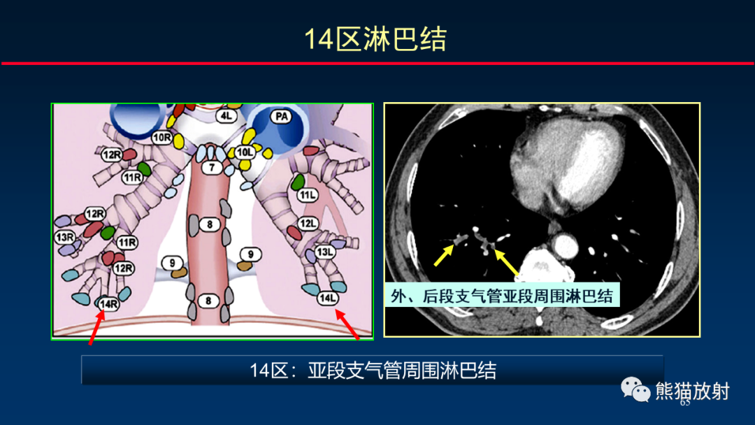 影像PPT - 【PPT】纵隔与肺门淋巴结的识别与精准CT分区-65