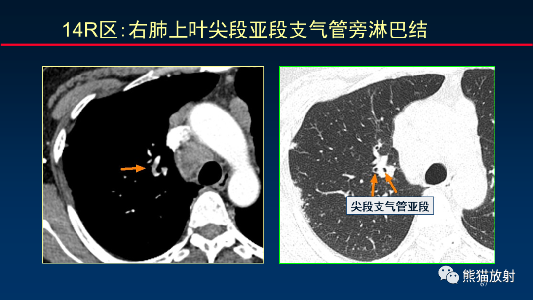 影像PPT - 【PPT】纵隔与肺门淋巴结的识别与精准CT分区-67