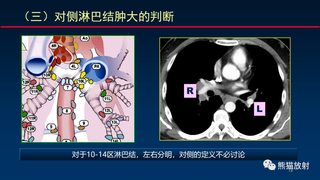 影像PPT - 【PPT】纵隔与肺门淋巴结的识别与精准CT分区-73
