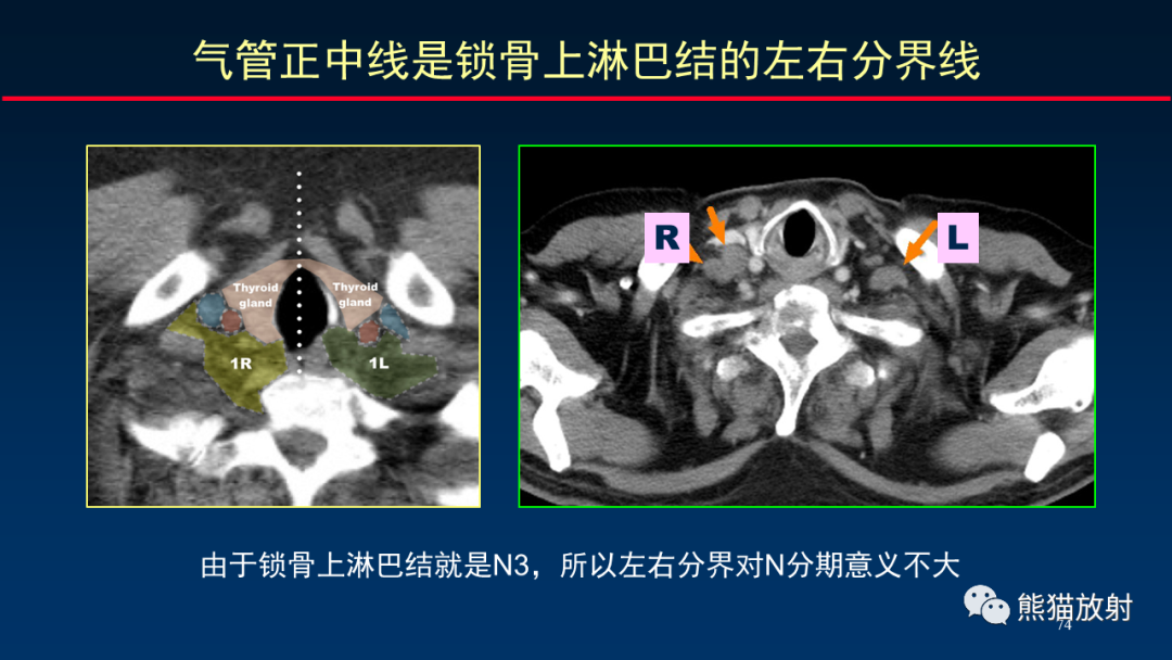 影像PPT - 【PPT】纵隔与肺门淋巴结的识别与精准CT分区-74