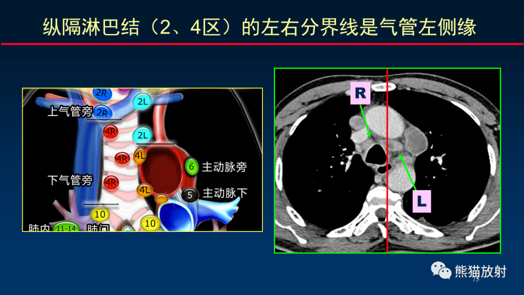 影像PPT - 【PPT】纵隔与肺门淋巴结的识别与精准CT分区-75