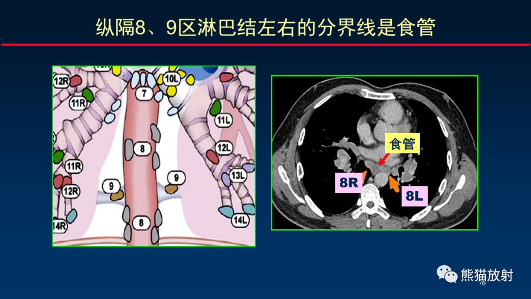 影像PPT - 【PPT】纵隔与肺门淋巴结的识别与精准CT分区-76