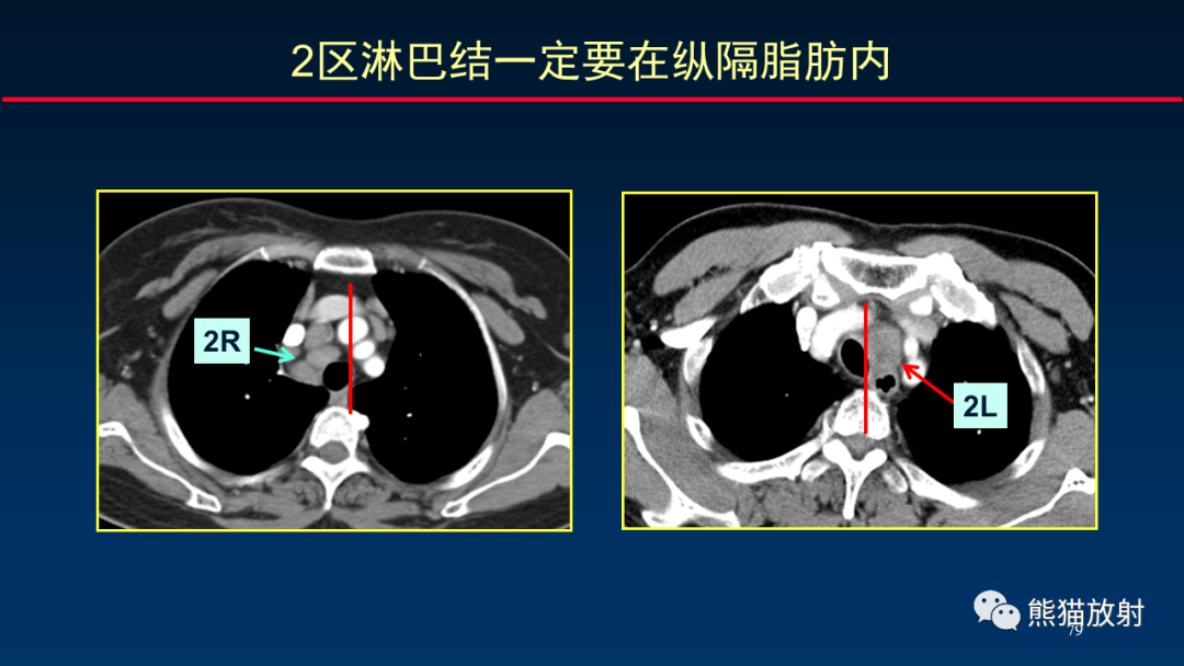 影像PPT - 【PPT】纵隔与肺门淋巴结的识别与精准CT分区-79
