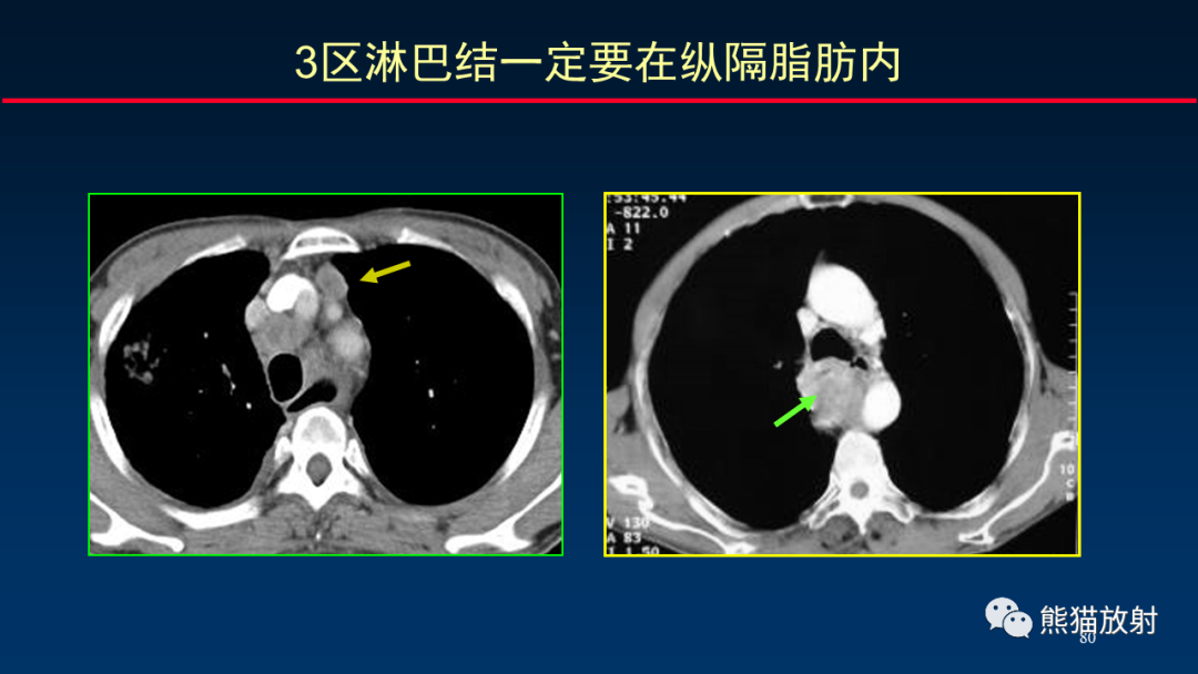影像PPT - 【PPT】纵隔与肺门淋巴结的识别与精准CT分区-80