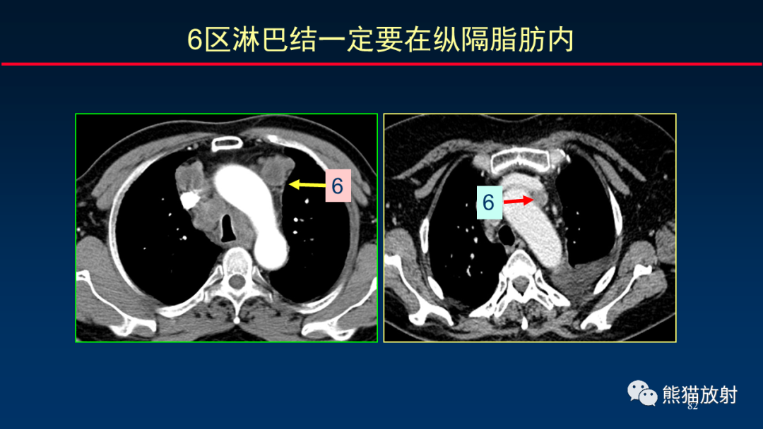 影像PPT - 【PPT】纵隔与肺门淋巴结的识别与精准CT分区-82