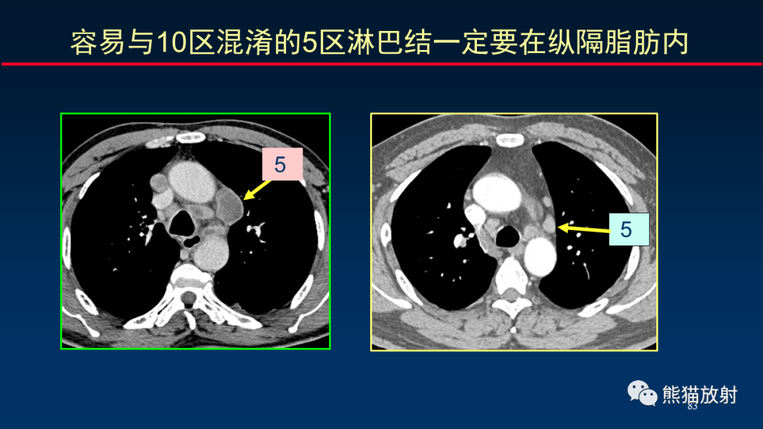 影像PPT - 【PPT】纵隔与肺门淋巴结的识别与精准CT分区-83