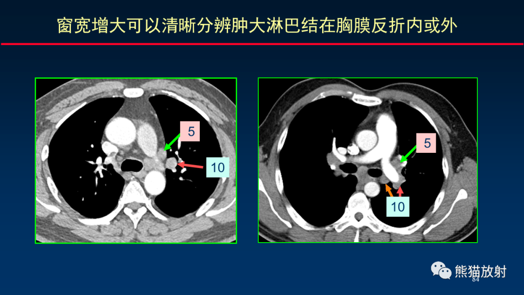 影像PPT - 【PPT】纵隔与肺门淋巴结的识别与精准CT分区-84
