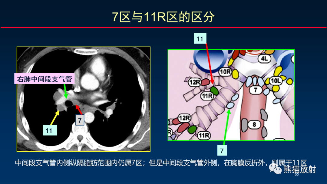 影像PPT - 【PPT】纵隔与肺门淋巴结的识别与精准CT分区-85