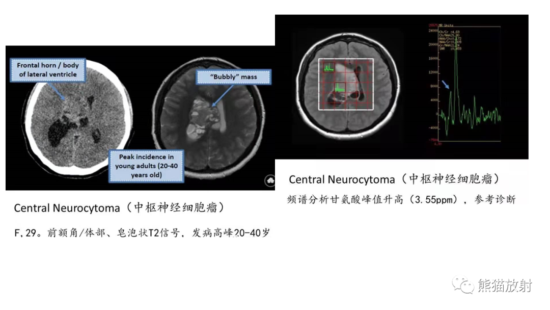 影像PPT - 【病例】中枢神经细胞瘤2例MR影像-19