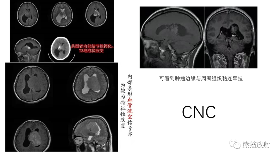 影像PPT - 【病例】中枢神经细胞瘤2例MR影像-20