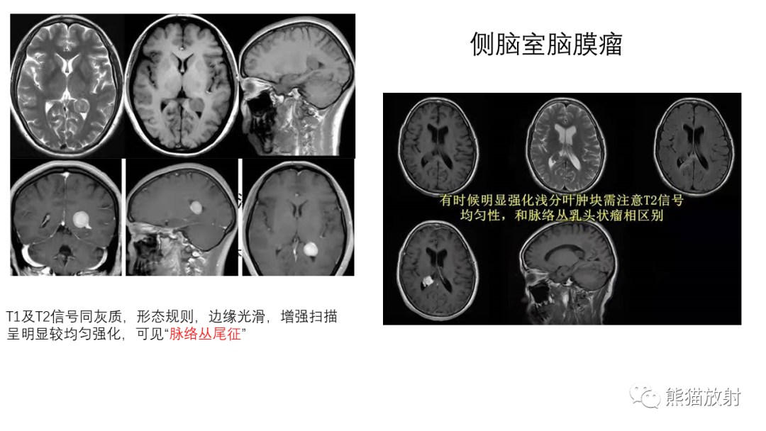 影像PPT - 【病例】中枢神经细胞瘤2例MR影像-23