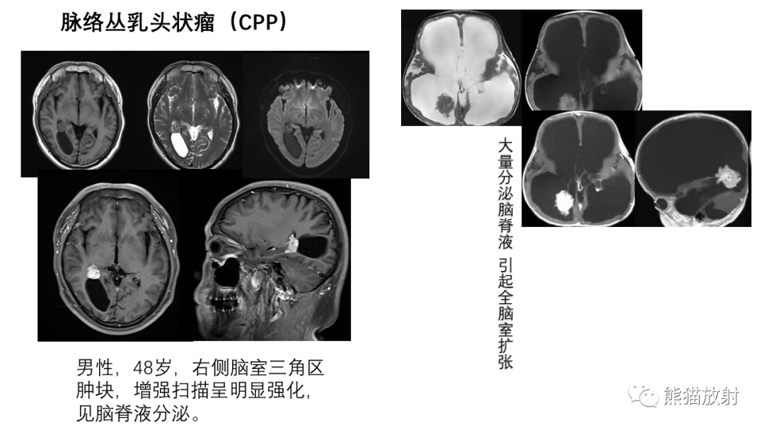 影像PPT - 【病例】中枢神经细胞瘤2例MR影像-26