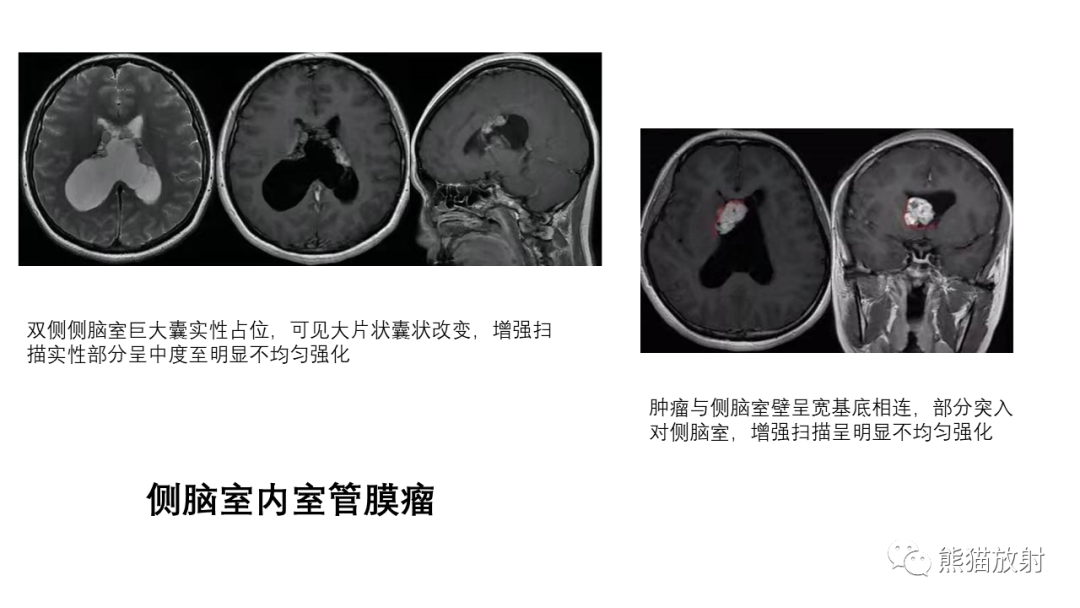 影像PPT - 【病例】中枢神经细胞瘤2例MR影像-28