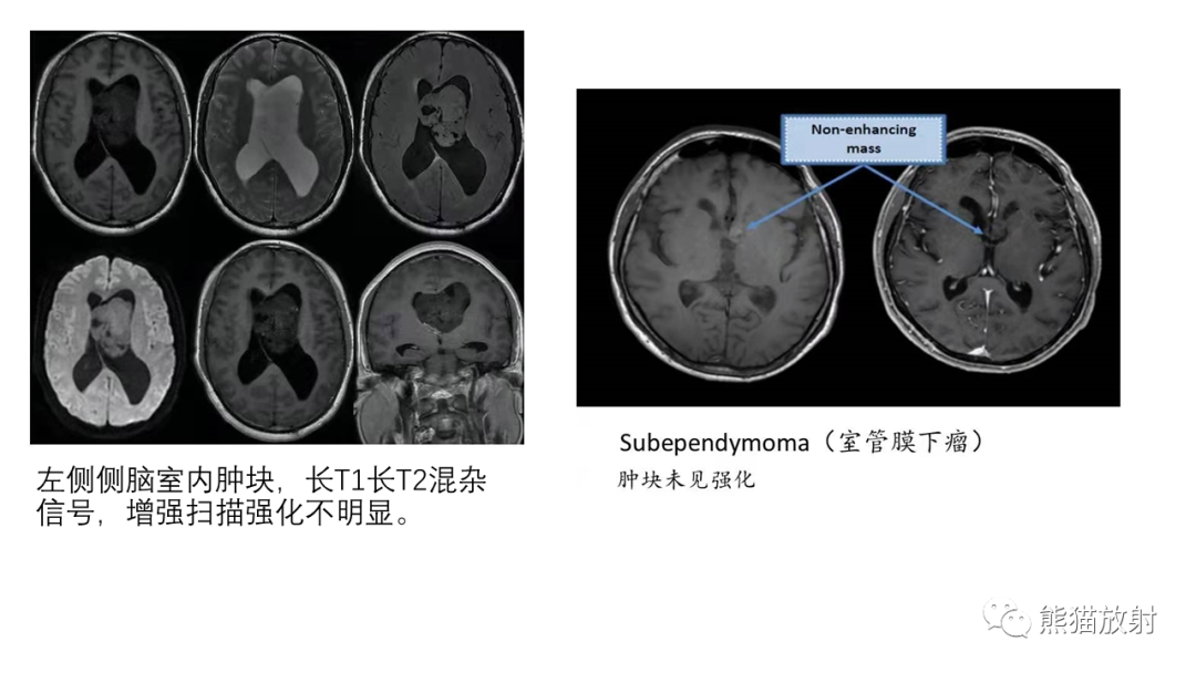 影像PPT - 【病例】中枢神经细胞瘤2例MR影像-30