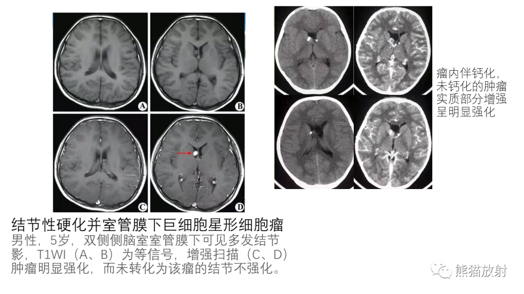 影像PPT - 【病例】中枢神经细胞瘤2例MR影像-32
