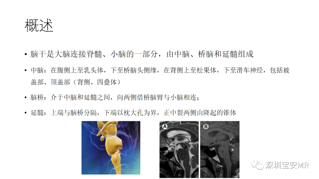 影像PPT - 【PPT】儿童脑干病变的MRI表现-2