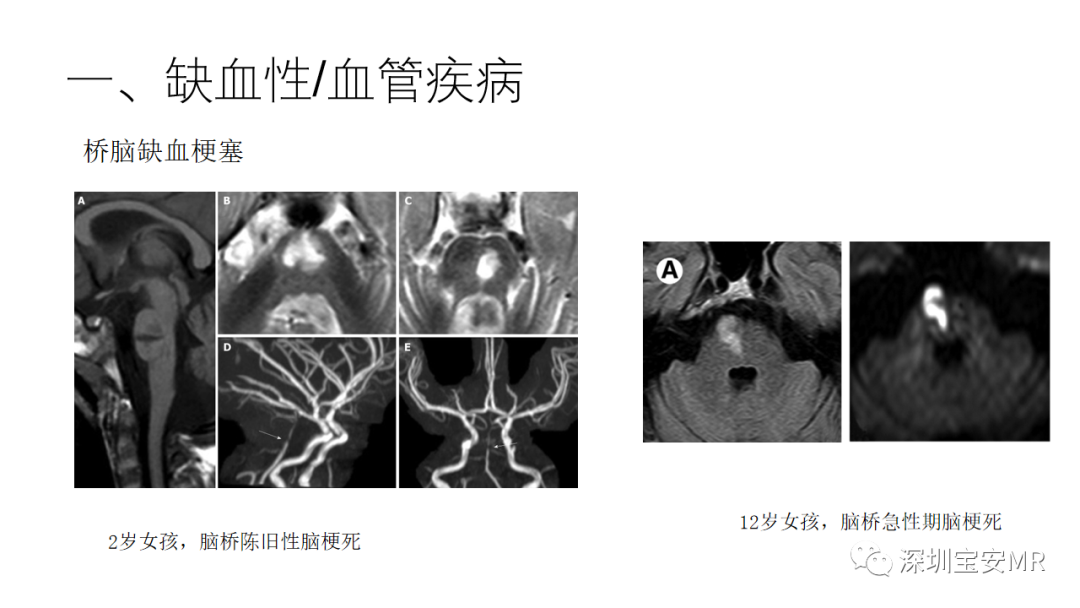 影像PPT - 【PPT】儿童脑干病变的MRI表现-6