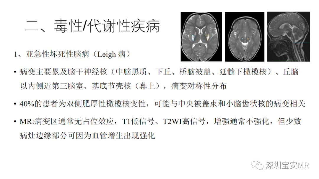 影像PPT - 【PPT】儿童脑干病变的MRI表现-10