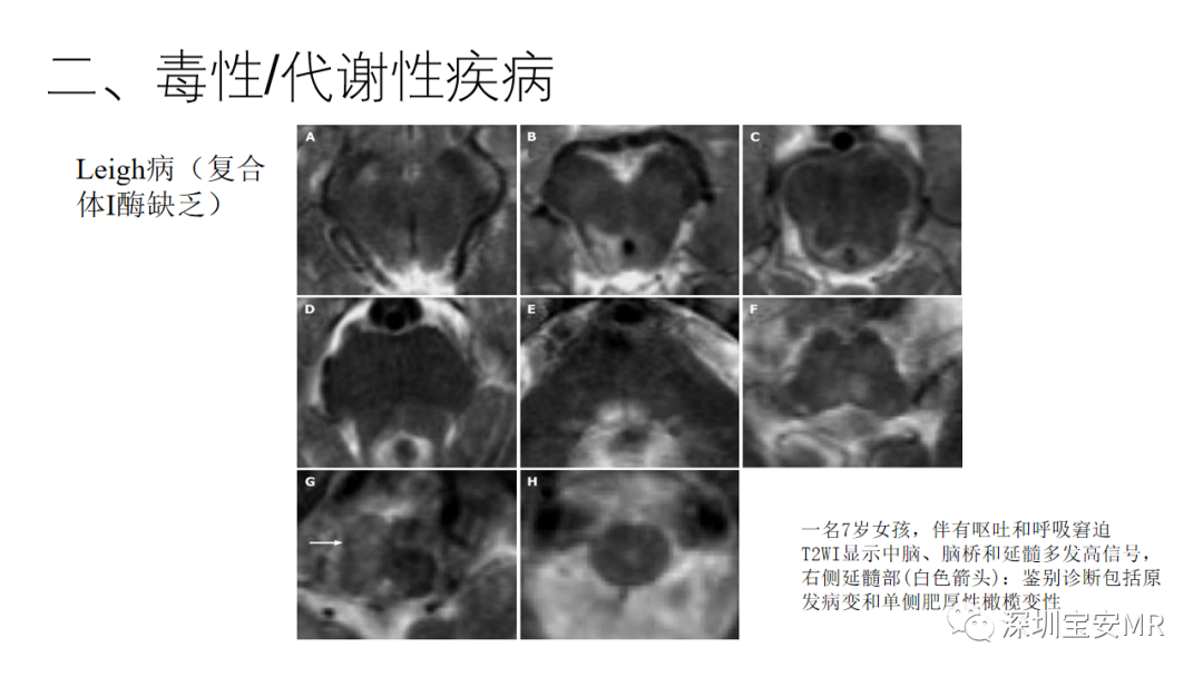 影像PPT - 【PPT】儿童脑干病变的MRI表现-12