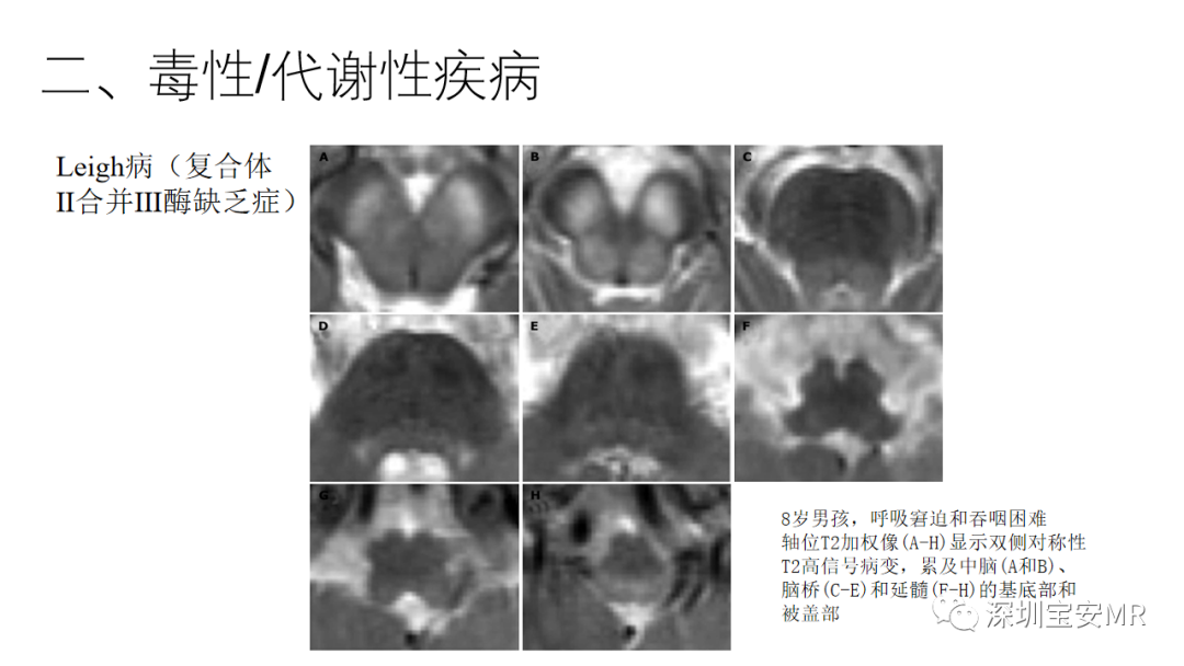 影像PPT - 【PPT】儿童脑干病变的MRI表现-13