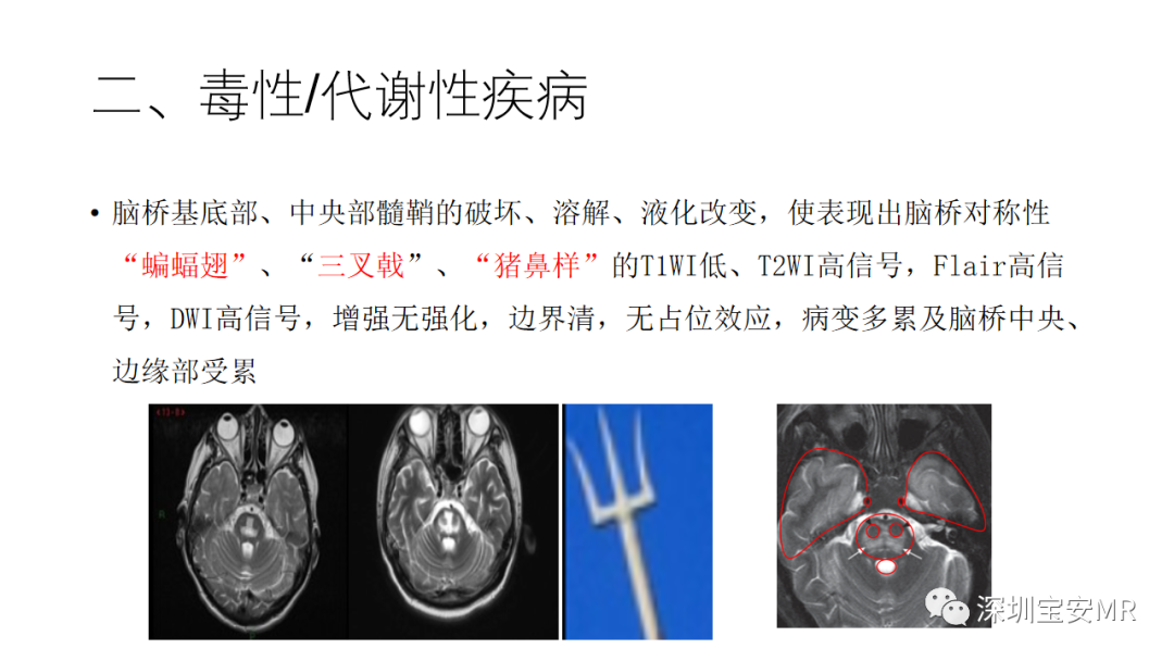 影像PPT - 【PPT】儿童脑干病变的MRI表现-15