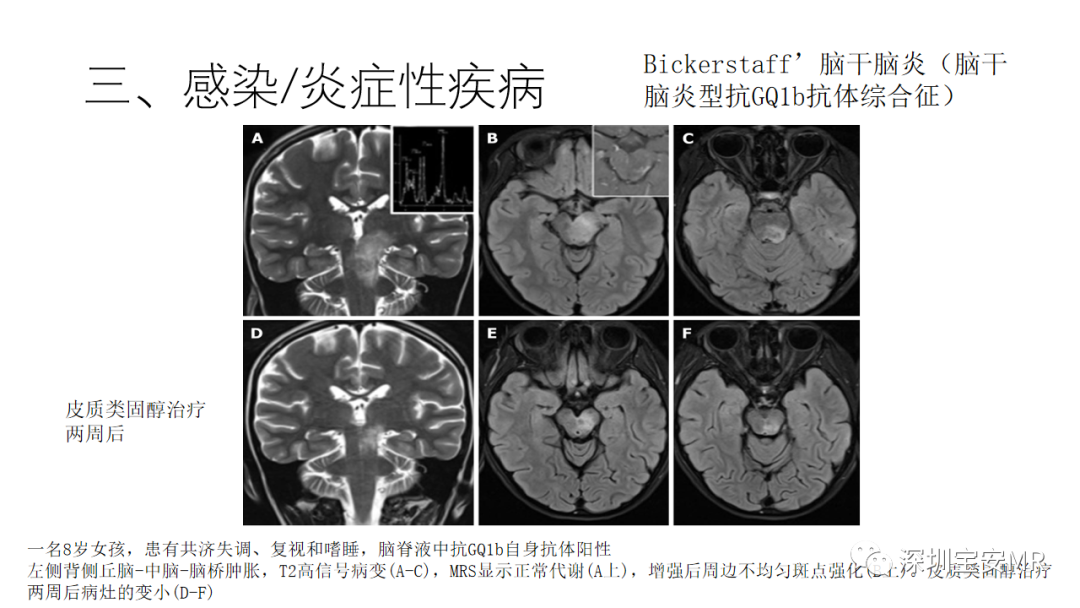 影像PPT - 【PPT】儿童脑干病变的MRI表现-19