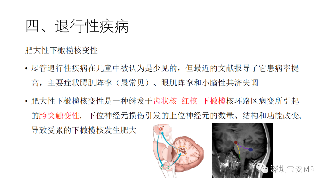 影像PPT - 【PPT】儿童脑干病变的MRI表现-26