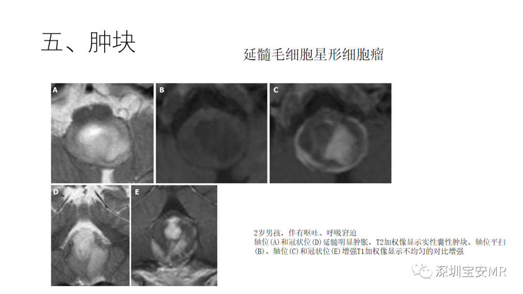 影像PPT - 【PPT】儿童脑干病变的MRI表现-32
