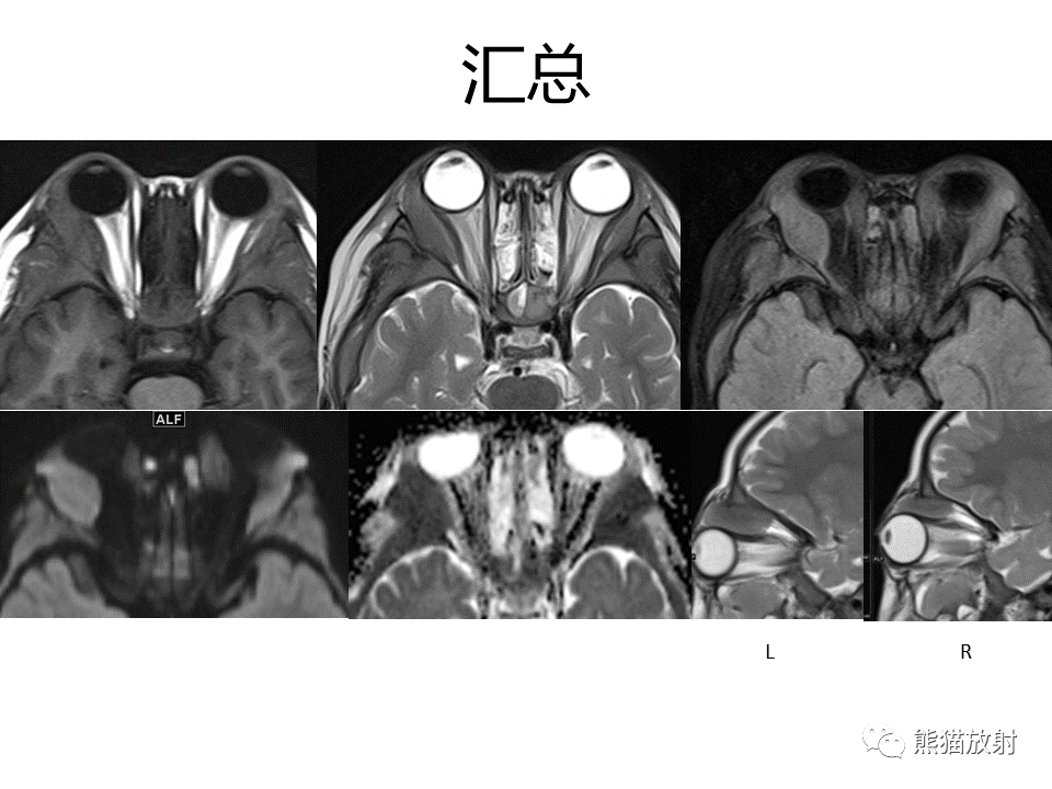 影像PPT - 【病例】眼眶绿色瘤 VS 淋巴瘤-10