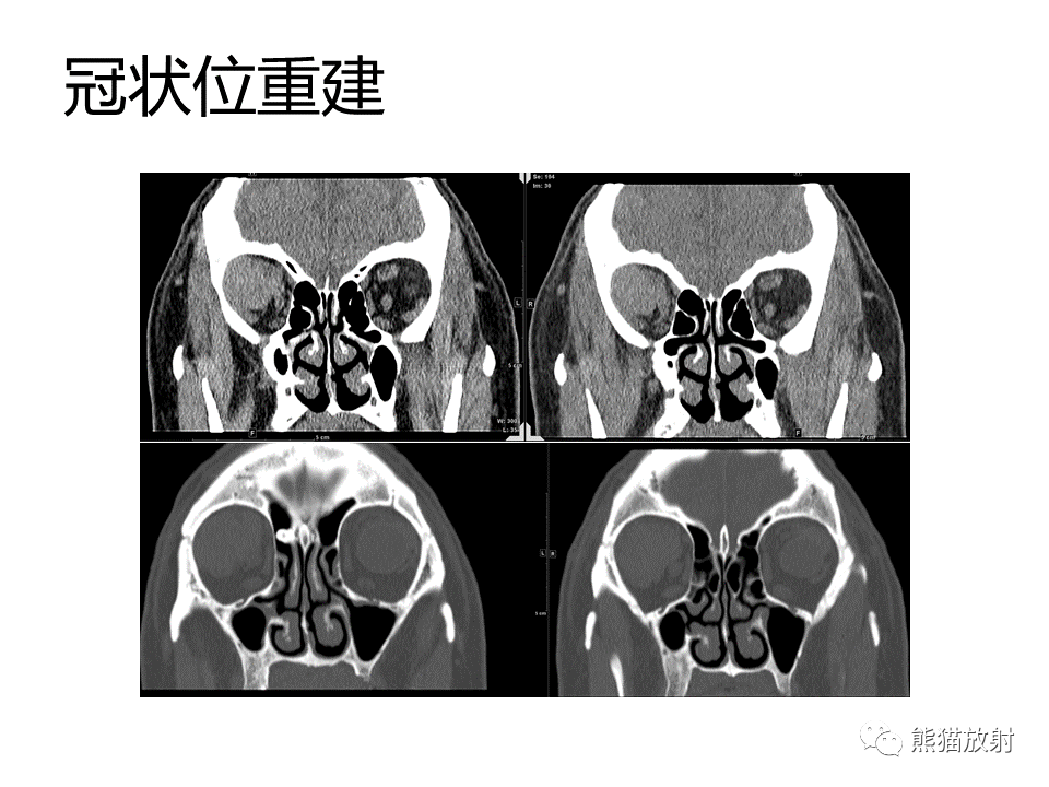 影像PPT - 【病例】眼眶绿色瘤 VS 淋巴瘤-16