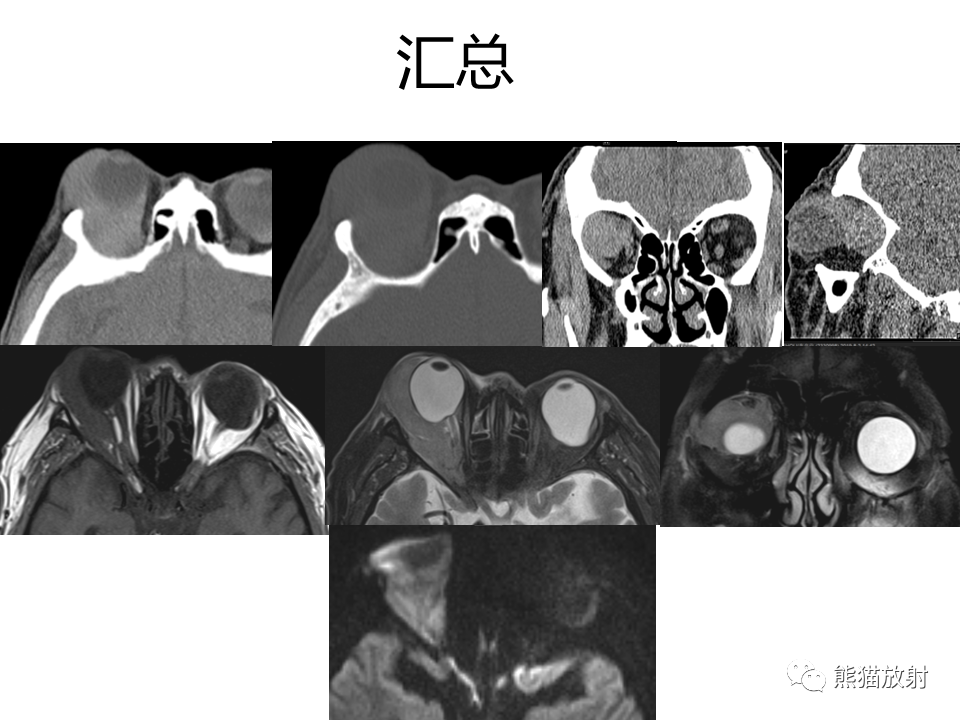 影像PPT - 【病例】眼眶绿色瘤 VS 淋巴瘤-22