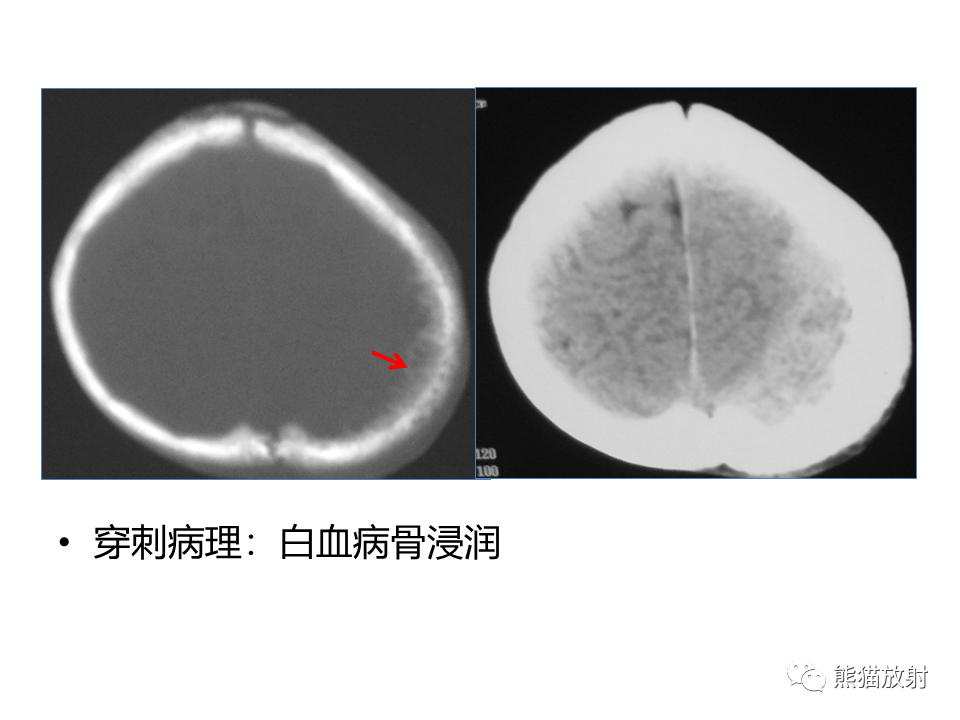 影像PPT - 【病例】眼眶绿色瘤 VS 淋巴瘤-29