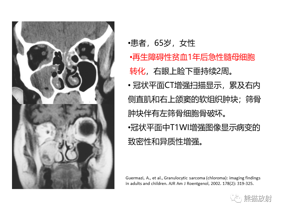影像PPT - 【病例】眼眶绿色瘤 VS 淋巴瘤-30