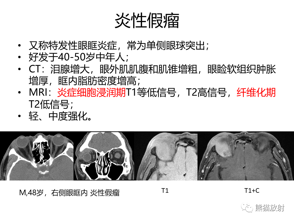 影像PPT - 【病例】眼眶绿色瘤 VS 淋巴瘤-34