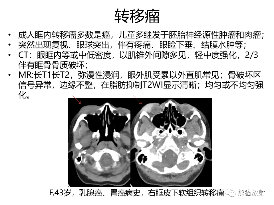 影像PPT - 【病例】眼眶绿色瘤 VS 淋巴瘤-37
