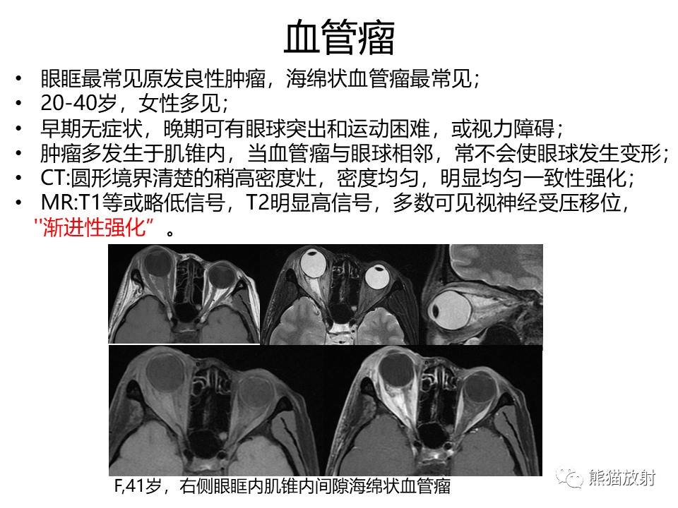 影像PPT - 【病例】眼眶绿色瘤 VS 淋巴瘤-36