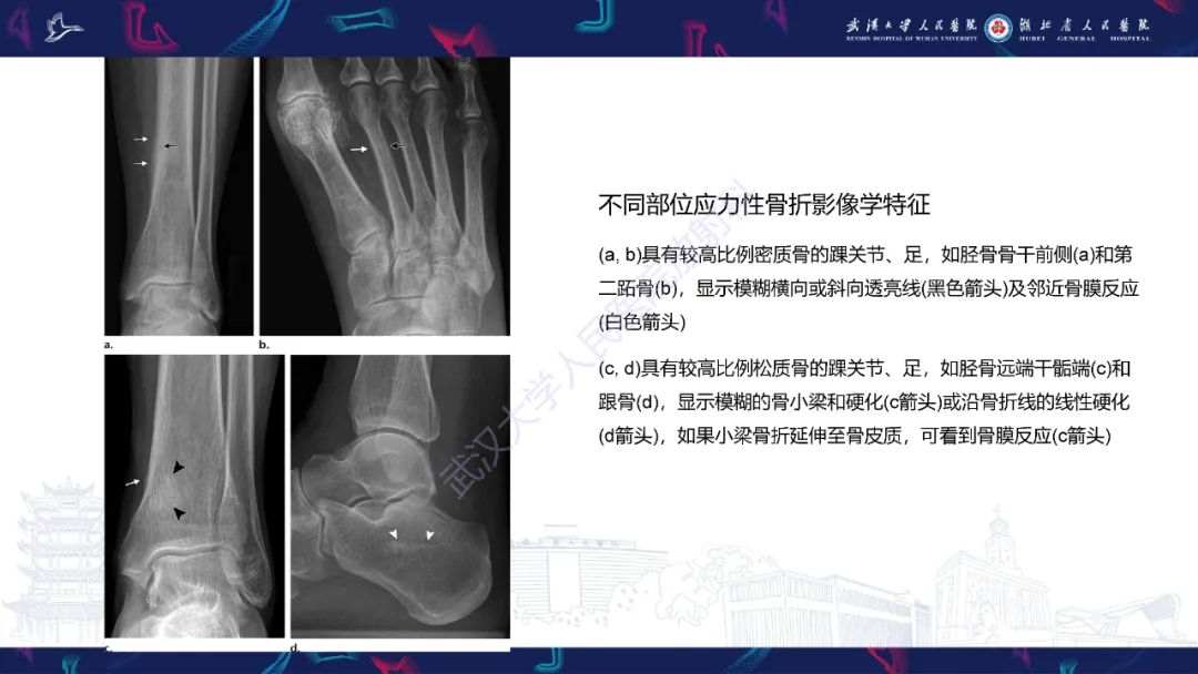 影像PPT - 一定要注意“可怕的黑线征”(dreaded black line)-12 影像PPT - 一定要注意“可怕的黑线征”(dreaded black line)-12