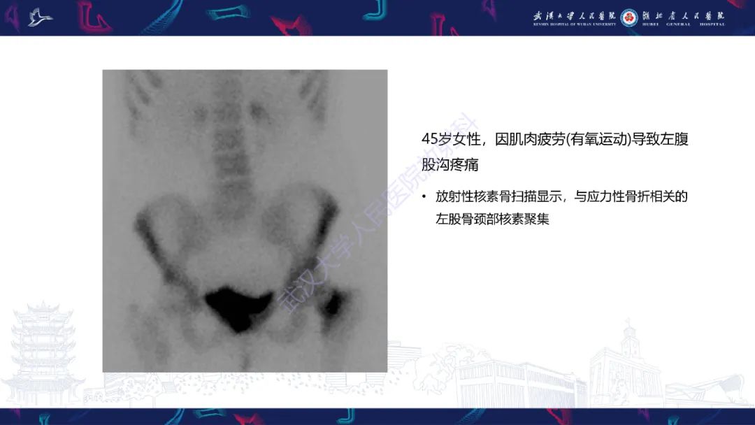 影像PPT - 一定要注意“可怕的黑线征”(dreaded black line)-14 影像PPT - 一定要注意“可怕的黑线征”(dreaded black line)-14