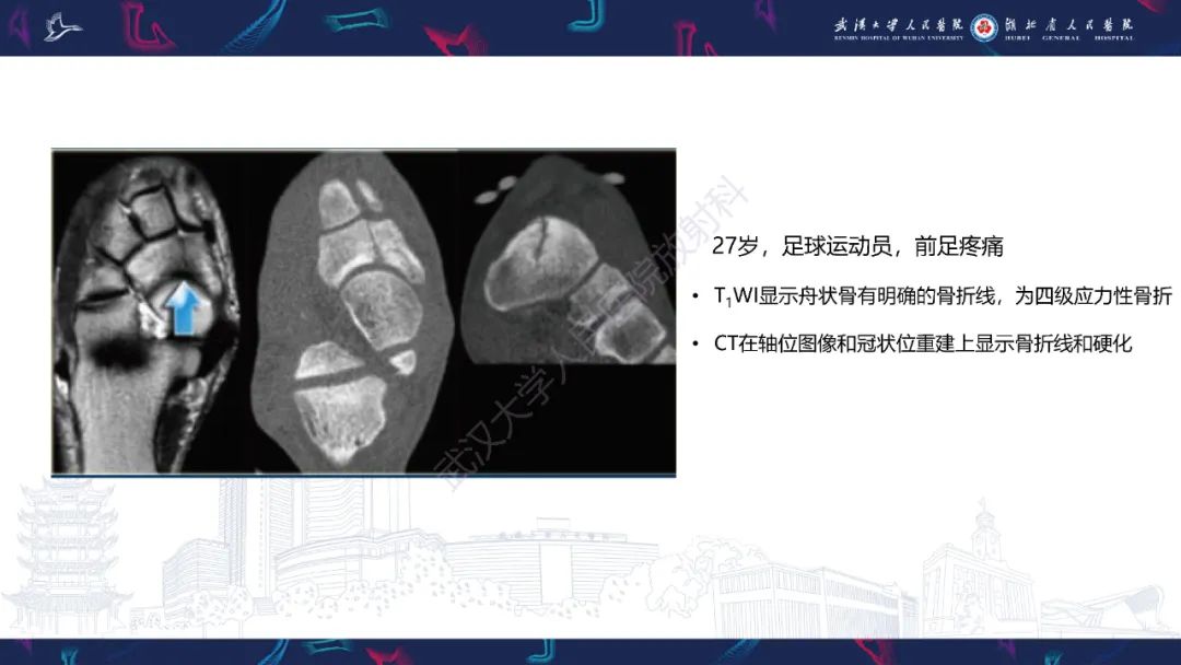 影像PPT - 一定要注意“可怕的黑线征”(dreaded black line)-19 影像PPT - 一定要注意“可怕的黑线征”(dreaded black line)-19