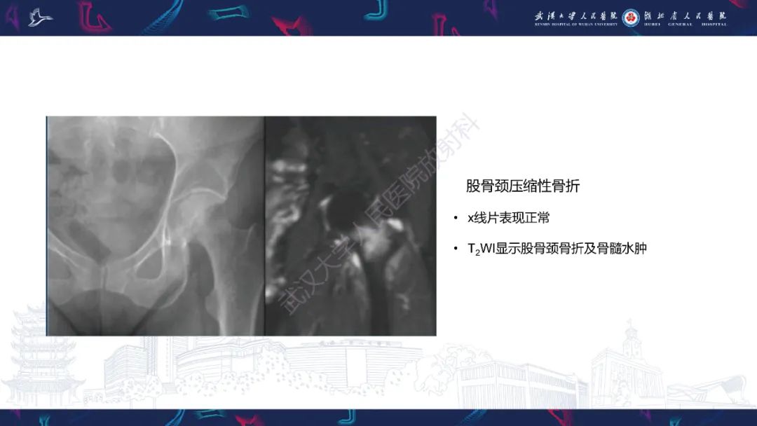 影像PPT - 一定要注意“可怕的黑线征”(dreaded black line)-21 影像PPT - 一定要注意“可怕的黑线征”(dreaded black line)-21