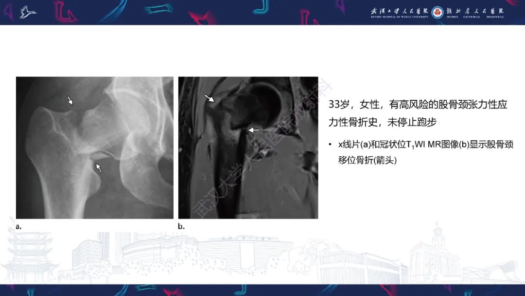 影像PPT - 一定要注意“可怕的黑线征”(dreaded black line)-23 影像PPT - 一定要注意“可怕的黑线征”(dreaded black line)-23