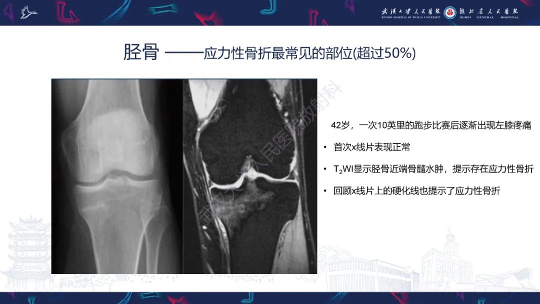 影像PPT - 一定要注意“可怕的黑线征”(dreaded black line)-24 影像PPT - 一定要注意“可怕的黑线征”(dreaded black line)-24