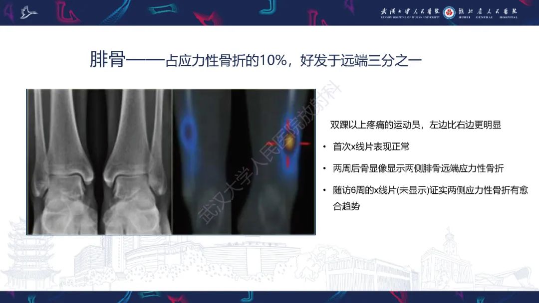 影像PPT - 一定要注意“可怕的黑线征”(dreaded black line)-26 影像PPT - 一定要注意“可怕的黑线征”(dreaded black line)-26