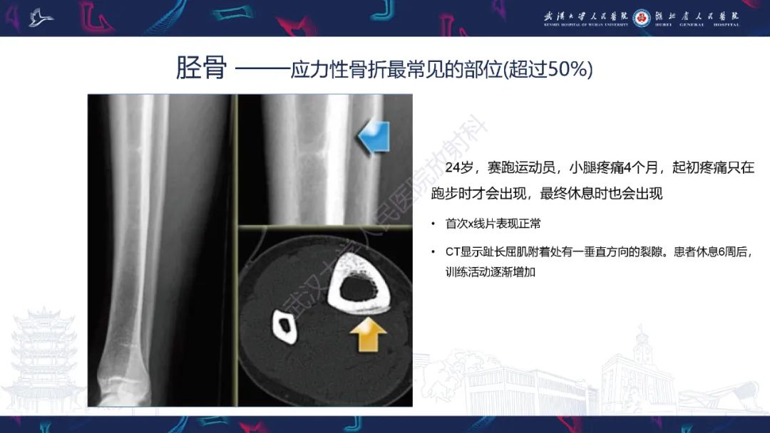 影像PPT - 一定要注意“可怕的黑线征”(dreaded black line)-25 影像PPT - 一定要注意“可怕的黑线征”(dreaded black line)-25