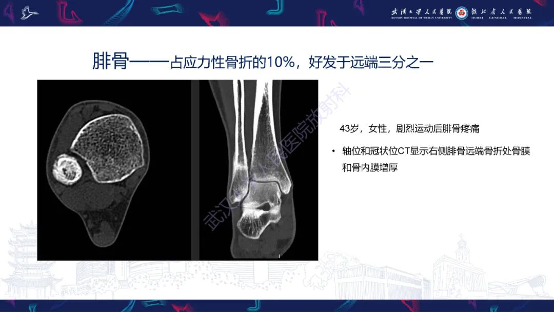 影像PPT - 一定要注意“可怕的黑线征”(dreaded black line)-27 影像PPT - 一定要注意“可怕的黑线征”(dreaded black line)-27
